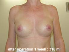 plastic-surgery-breast-augmentation 